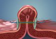USGI’s New Incisionless Endolumenal Bariatric Surgery Technology